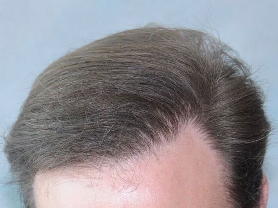 FUT Hair Restoration: Case 33 - After