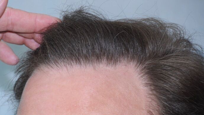 FUT Hair Restoration: Case 33 - Before