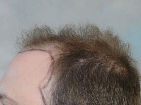 FUT Hair Restoration: Case 33 - Before