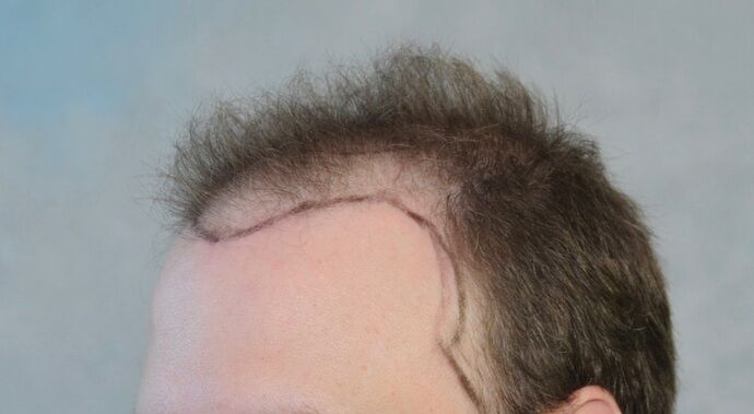 FUT Hair Restoration: Case 33 - After