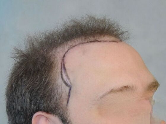 FUT Hair Restoration: Case 33 - Before