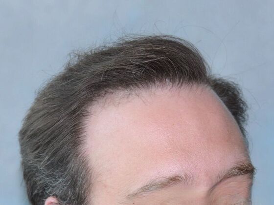FUT Hair Restoration: Case 33 - After