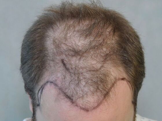 FUT Hair Restoration: Case 33 - Before