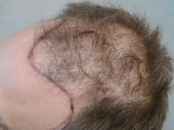 FUT Hair Restoration: Case 33 - Before