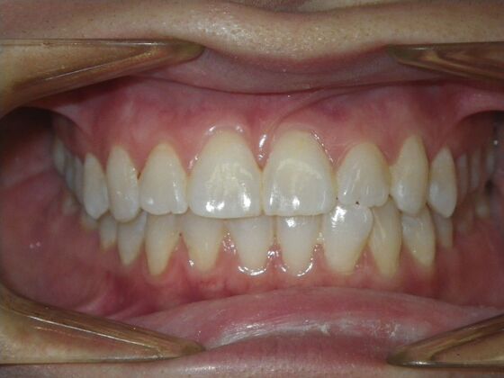 Invisalign: Case 18 - Before