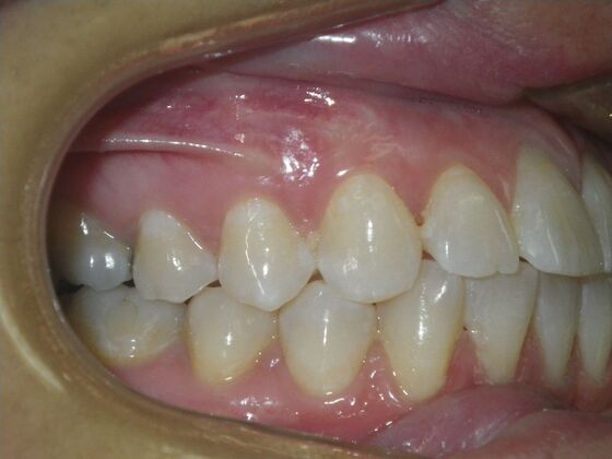 Invisalign: Case 18 - Before