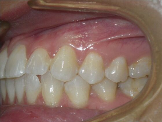 Invisalign: Case 18 - Before