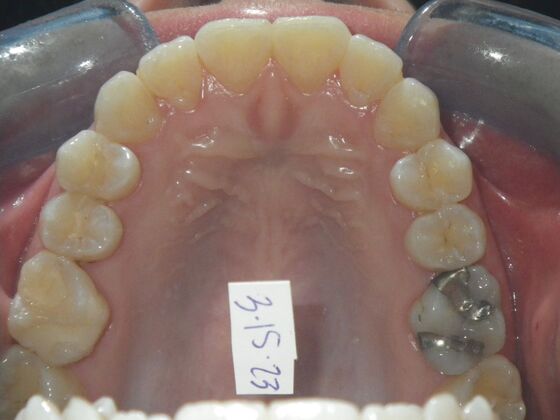Invisalign: Case 18 - Before