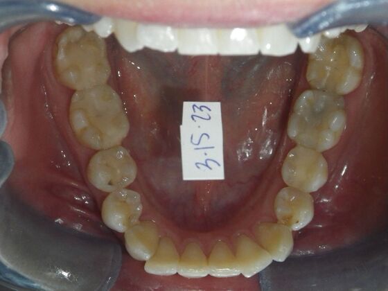 Invisalign: Case 18 - Before