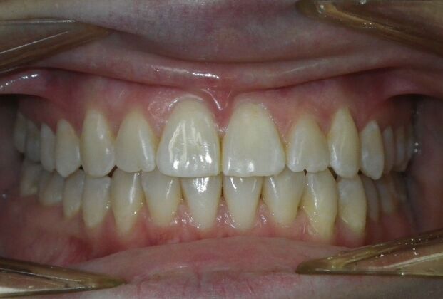 Invisalign: Case 18 - After