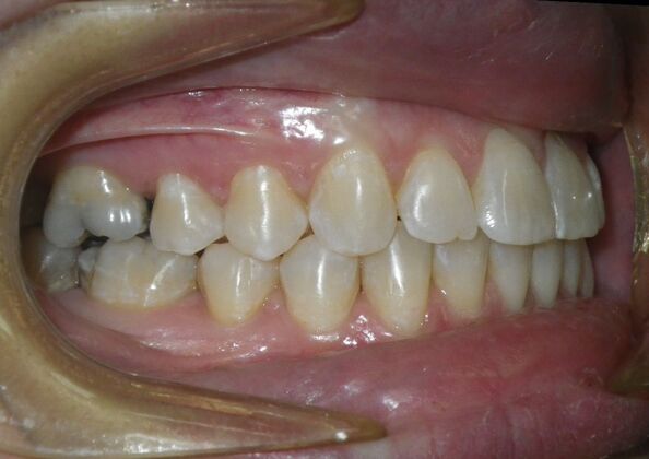 Invisalign: Case 18 - After