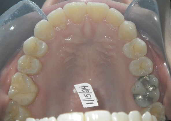 Invisalign: Case 18 - After