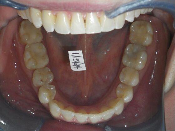 Invisalign: Case 18 - After