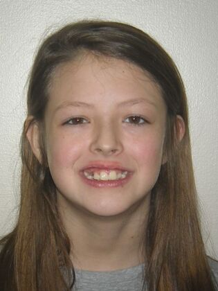 Orthodontics: Case 43 - Before