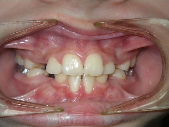 Orthodontics: Case 43 - Before
