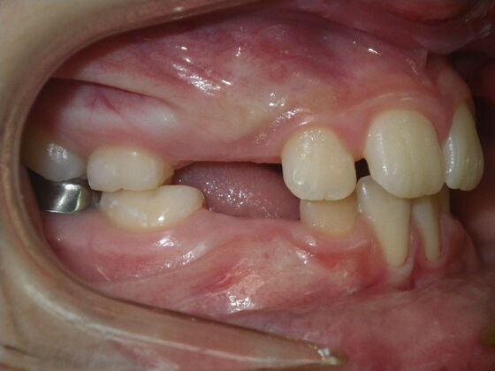 Orthodontics: Case 43 - Before