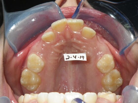 Orthodontics: Case 43 - Before