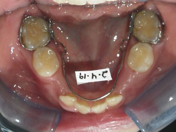 Orthodontics: Case 43 - Before