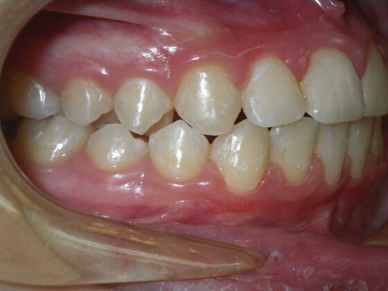 Orthodontics: Case 43 - After