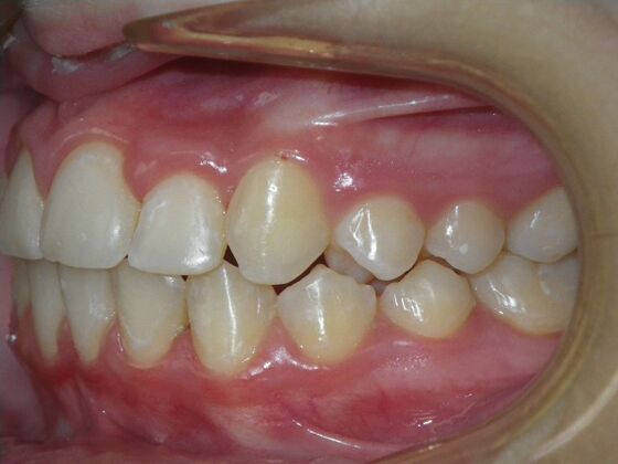 Orthodontics: Case 43 - After