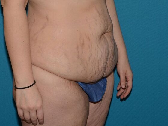 Torsoplasty: Case 1- Indianapolis - Before