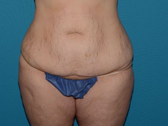 Torsoplasty Case 1- Indianapolis - Before