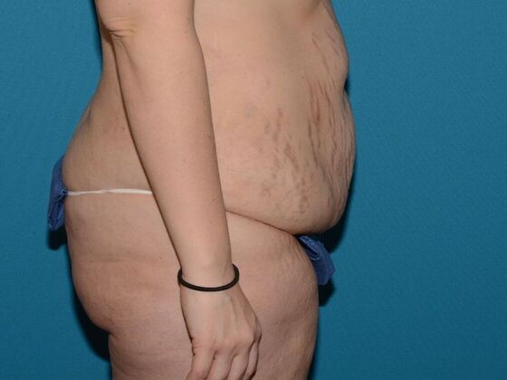 Torsoplasty: Case 1- Indianapolis - Before