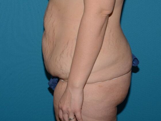 Torsoplasty: Case 1- Indianapolis - Before