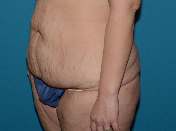 Torsoplasty: Case 1- Indianapolis - Before