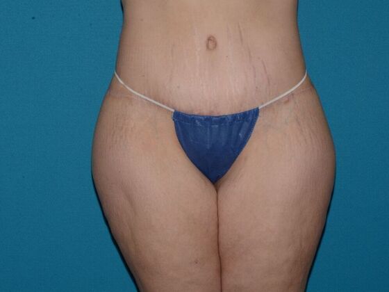 Torsoplasty Case 1- Indianapolis - After