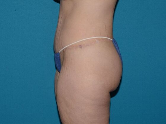 Torsoplasty: Case 1- Indianapolis - After