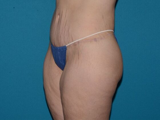 Torsoplasty: Case 1- Indianapolis - After