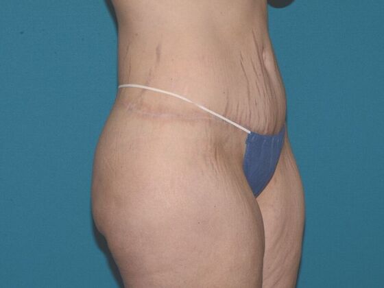 Torsoplasty: Case 1- Indianapolis - After