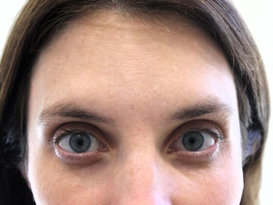 Injectables: Case 68 - After