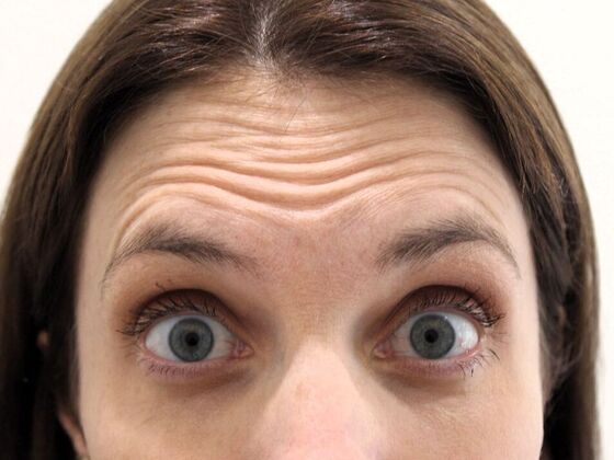 Injectables: Case 68 - Before