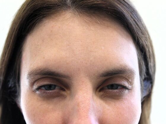 Injectables: Case 68 - After