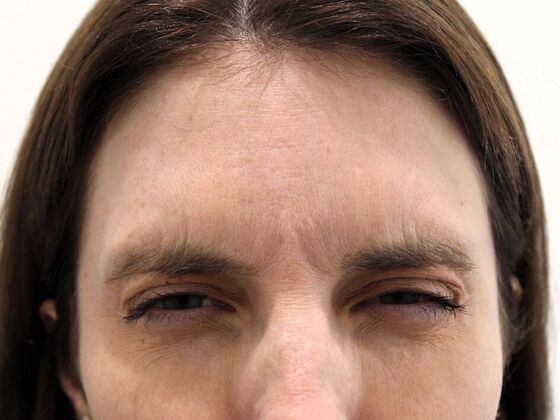 Injectables: Case 68 - Before