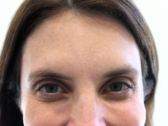 Injectables Case 68 - After