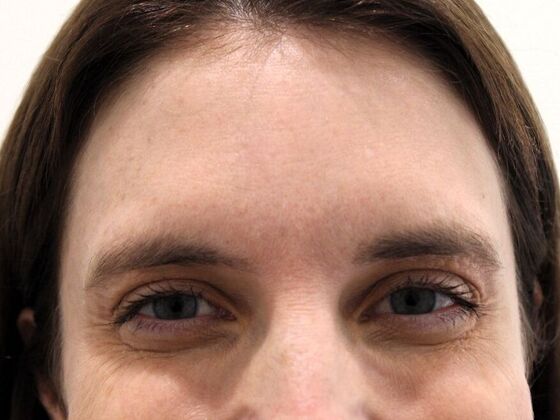 Injectables Case 68 - Before