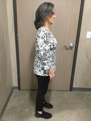 Gastric Sleeve: Case 5 - After