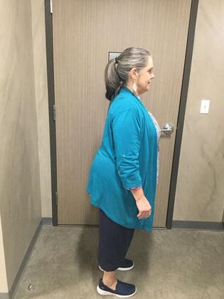 Gastric Sleeve: Case 5 - Before