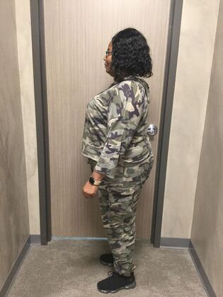 Gastric Sleeve: Case 6 - Before