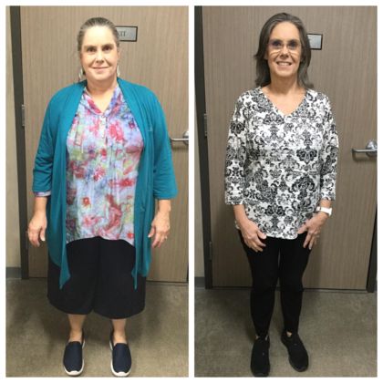 Gastric Sleeve: Case 5 - Before