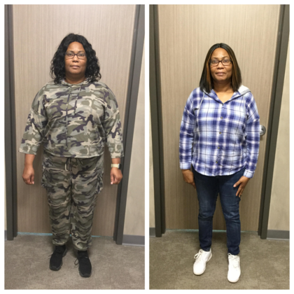 Gastric Sleeve: Case 6 - Before