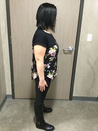 Gastric Sleeve: Case 7 - After