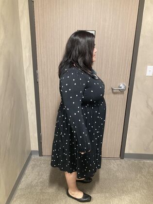 Gastric Sleeve: Case 7 - Before