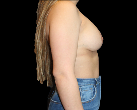 Breast Lift & Breast Lift Augmentation: Case 11 - After