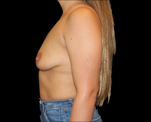 Breast Lift & Breast Lift Augmentation: Case 11 - Before