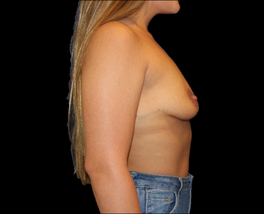 Breast Lift & Breast Lift Augmentation: Case 11 - Before