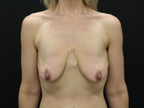Breast Lift & Breast Lift Augmentation Case 12 - Before